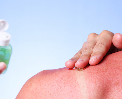 treating sunburn with acupuncture
