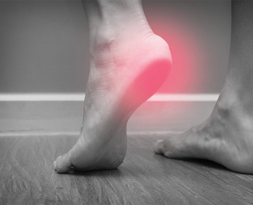 Plantar Fasciitis
