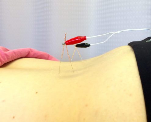 electro-acupuncture